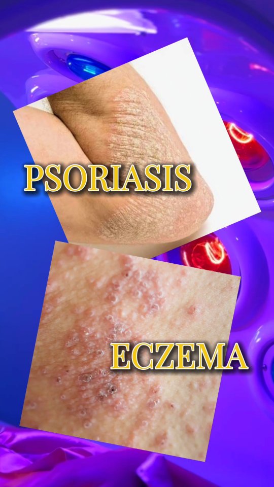 Roxie Where Beauty Begins - Mana Town Center, Kawit Facebook ad: Psoriasis? Eczema? Sumasakit na mga kasu-kasuan?