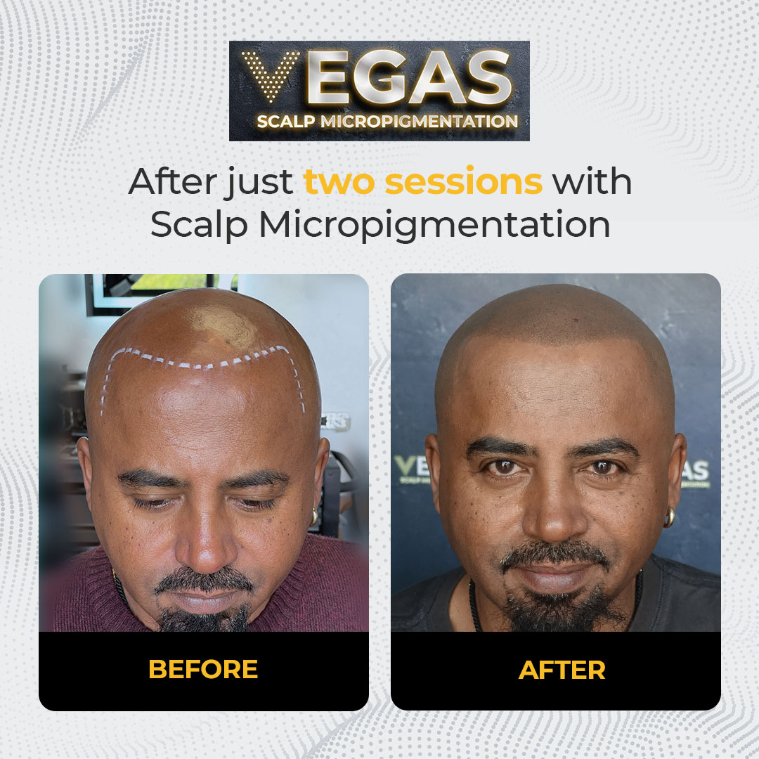 Vegas Scalp Micropigmentation Facebook ad: Las Vegas Hair Loss Solution, Award Winning SMP