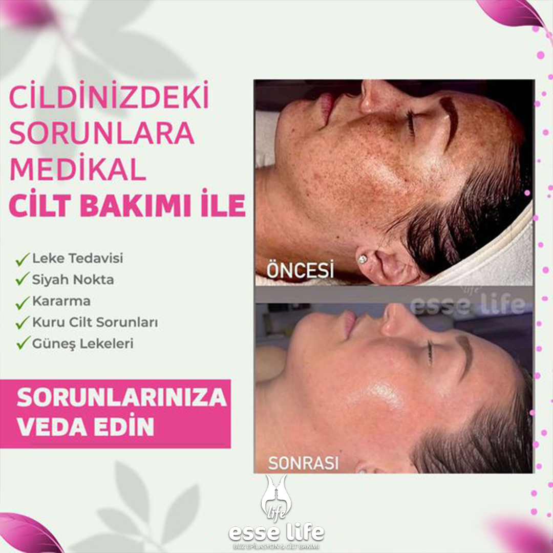 Esse Güzellik Aksaray Facebook ad: Kısa Süre Geçerli Cilt Bakımında %50 İndirim Fırsatını…