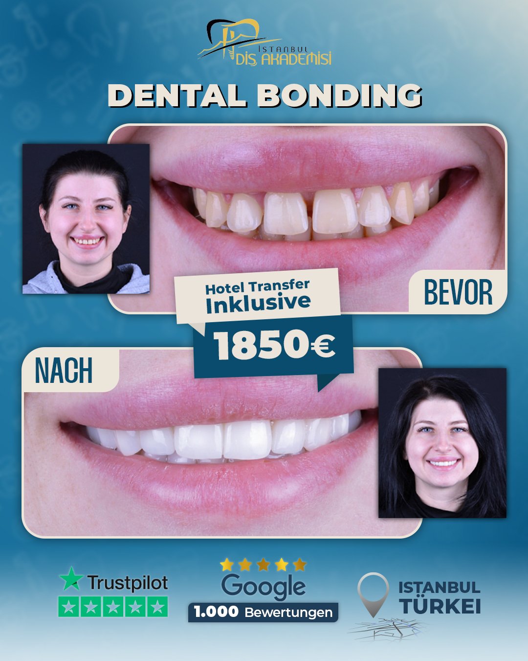 İstanbul Diş Akademisi Facebook ad: Dental Bonding in Istanbul