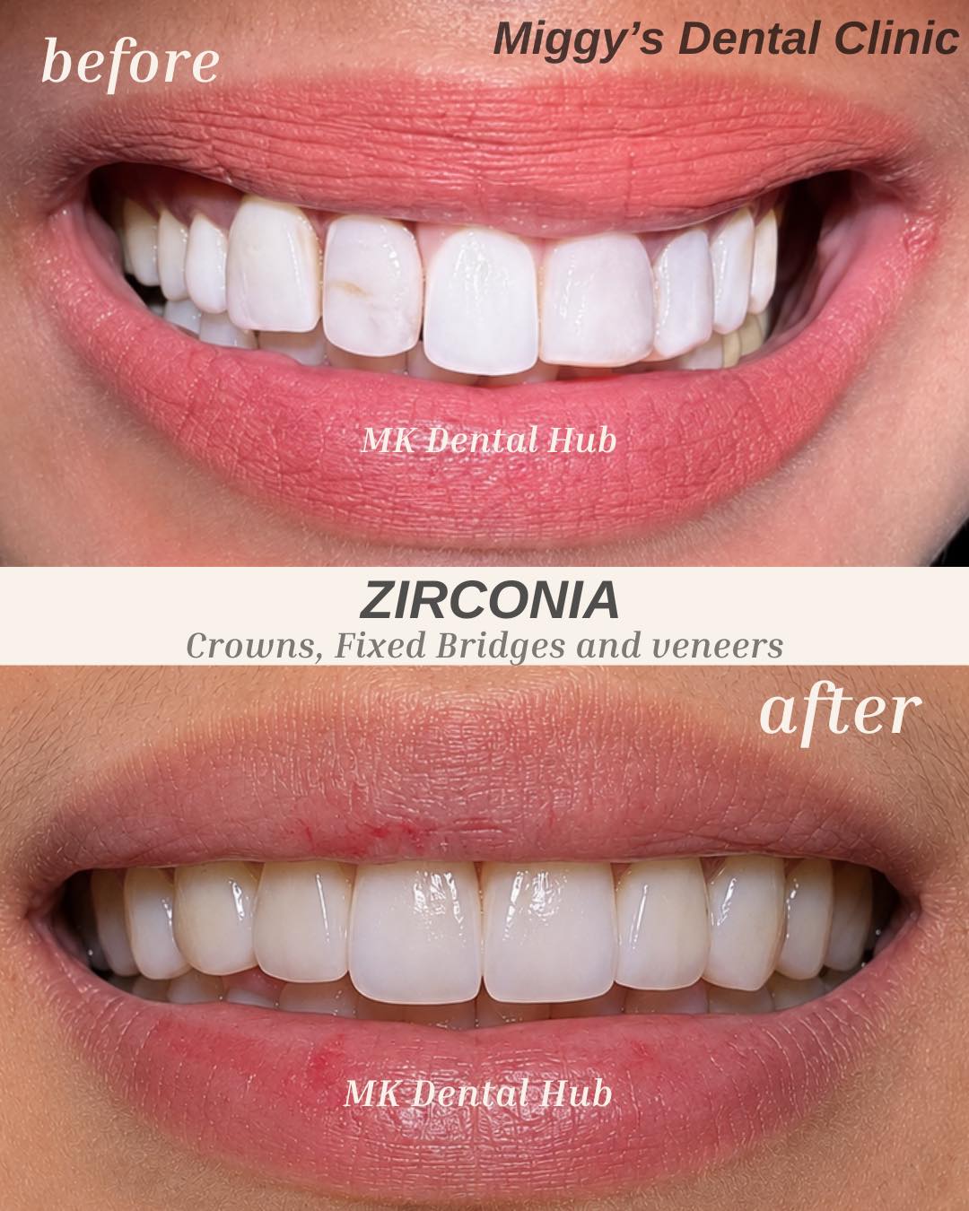 Miggy’s Dental Clinic Facebook ad: Before & After Transformation Zirconia Fixed bridge!