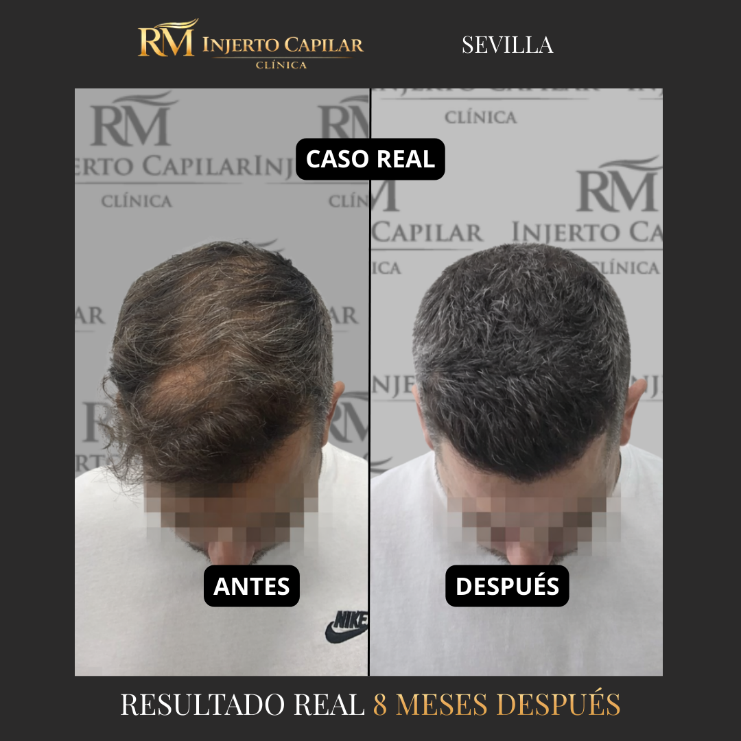 RM Injerto Capilar Facebook ad from Mar 16, 2026