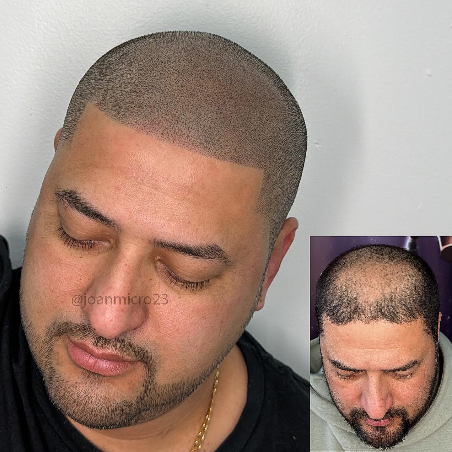 Joanmicro23 Facebook ad: Say bye to hair loss