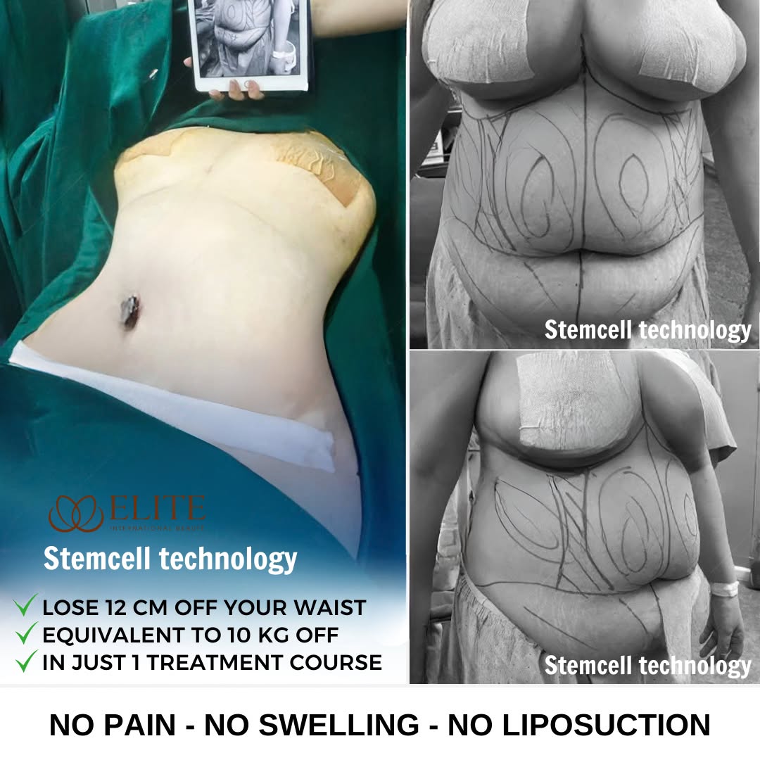 ELITE Premier Slimming & Wellness Center - Laguna Facebook ad: Disscount Up To 30% First 20 customers only