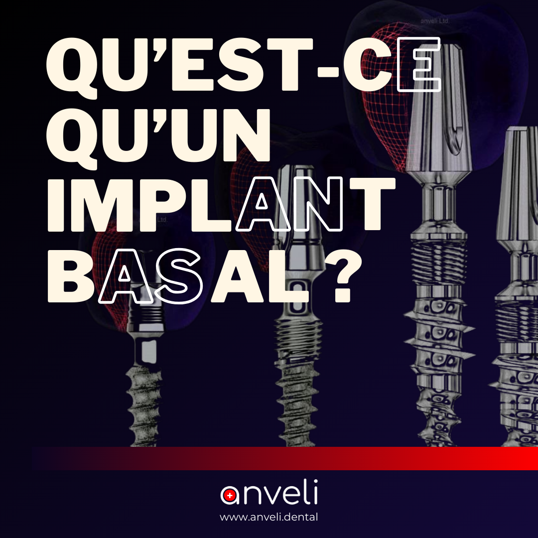 Anveli Dental Facebook ad: Contacts Anveli Dental - The Swiss Specialist Basal Implants