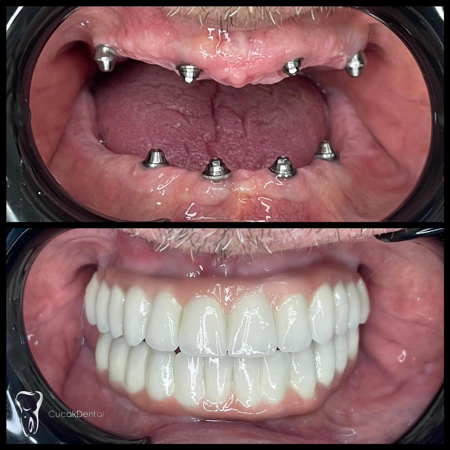 Cucak Dental Facebook ad: Zubni implantati All-on-4 pružaju dugoročnu opciju zamjene…