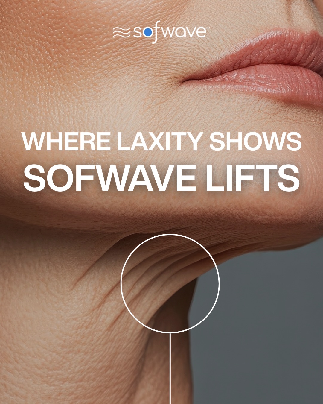 Sofwave Facebook ad