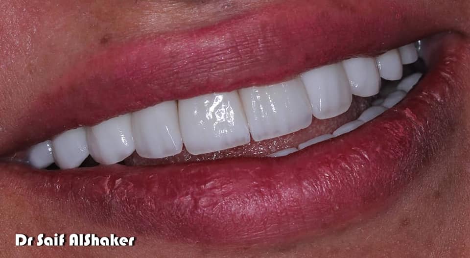 Dentist Saif Al Shaker Facebook ad: Full mouth rehabilitation.