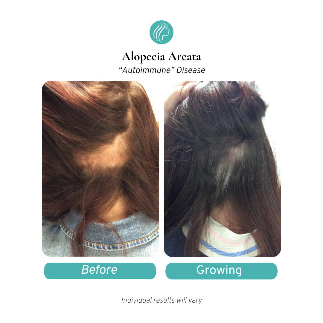 Medi Tresse Facebook ad: Get $500 off Painless PRP when you schedule…