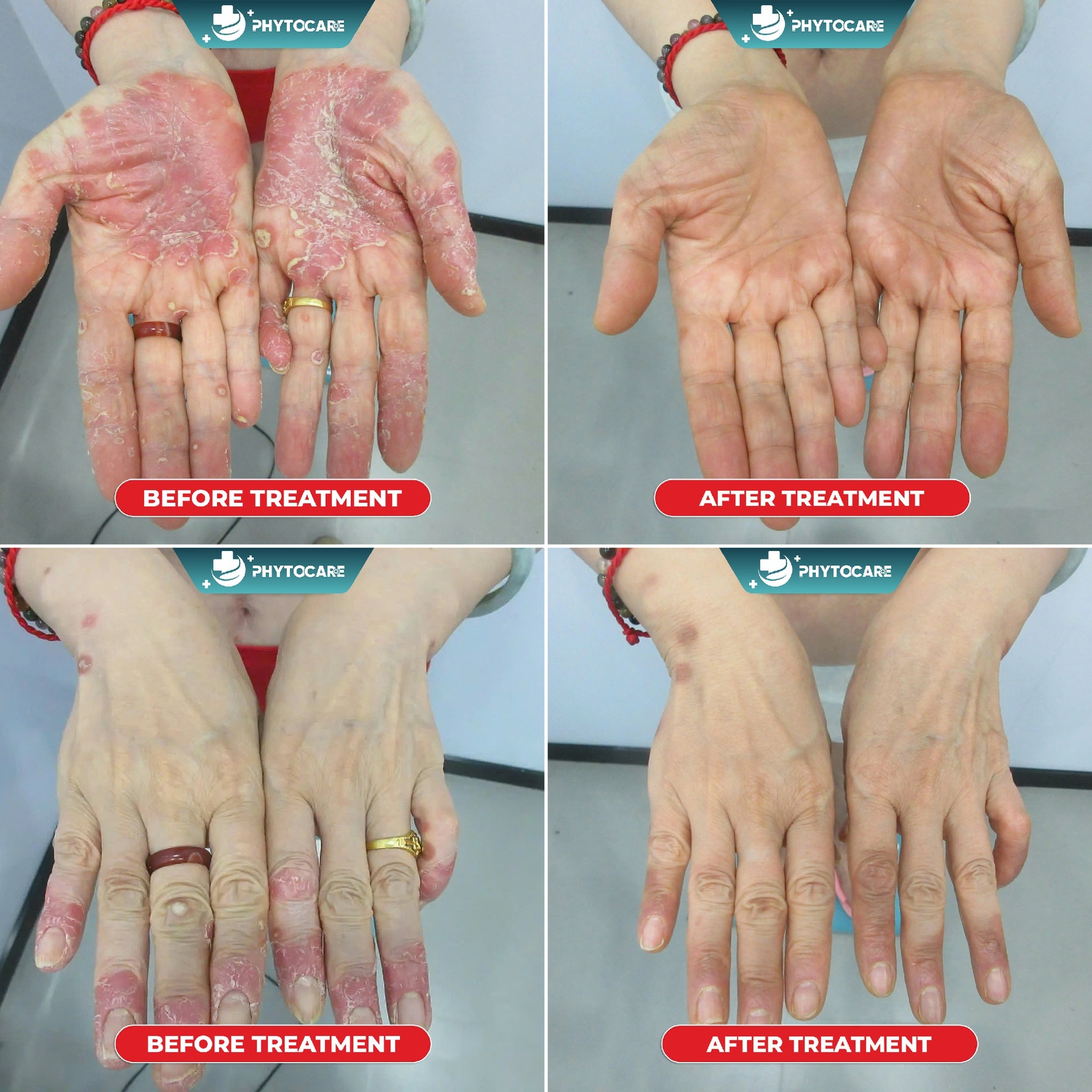 Phytocare Dermatology Clinic - Davao Facebook ad: 𝗗𝗢𝗡’𝗧 𝗜𝗚𝗡𝗢𝗥𝗘 𝗬𝗢𝗨𝗥 𝗦𝗞𝗜𝗡!
