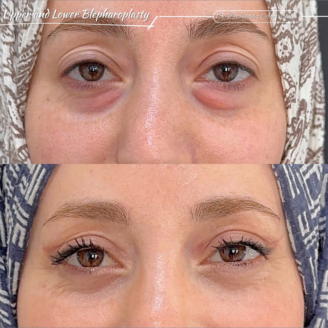 opdryildizacarebcim Facebook ad: Upper and Lower Blepharoplasty postop 1st month