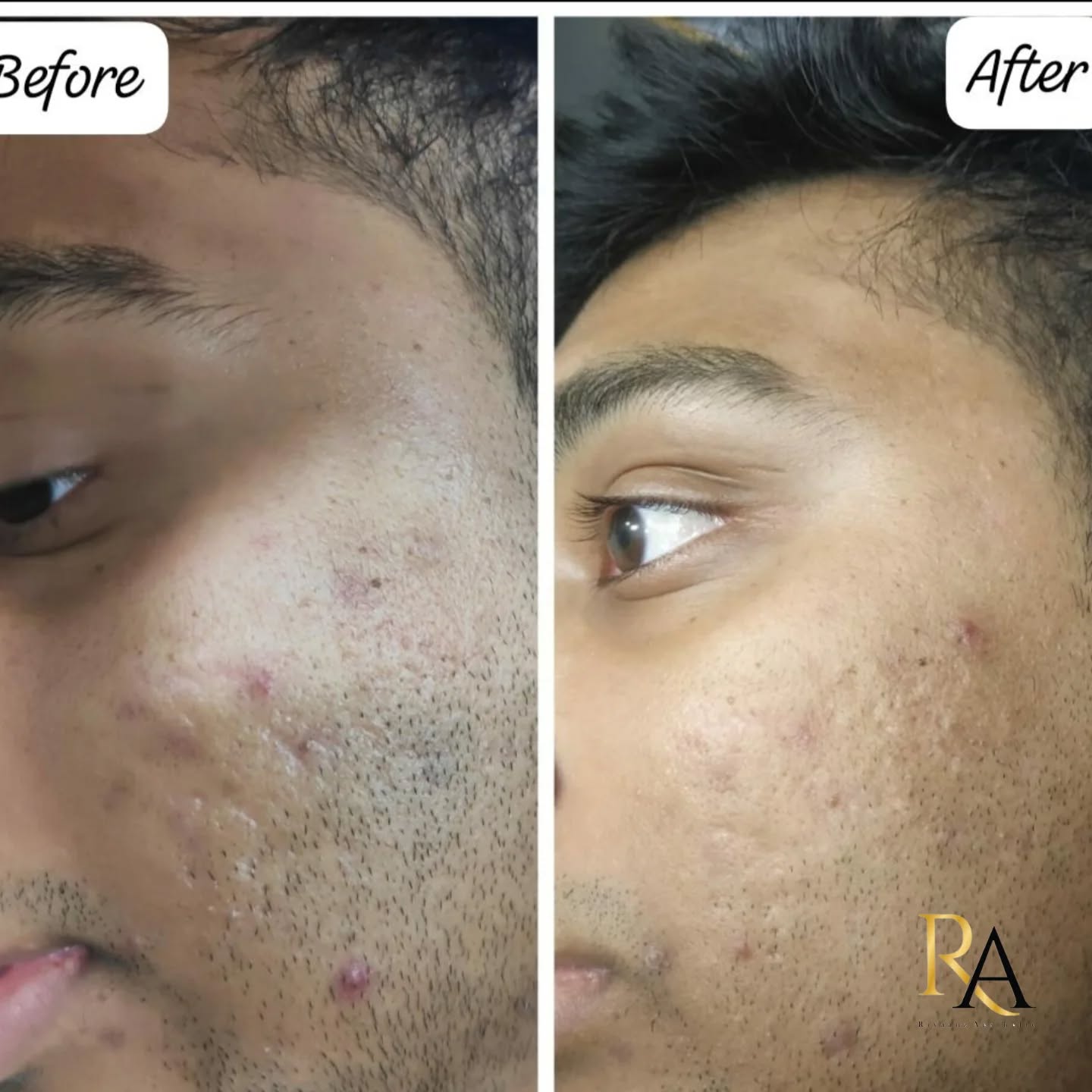 Riyaanz Aesthetic Laser Tattoo Removal Facebook ad