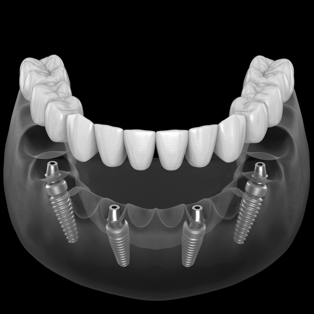 Ollie & Darsh Facebook ad: FREE Dental Implant Consultation