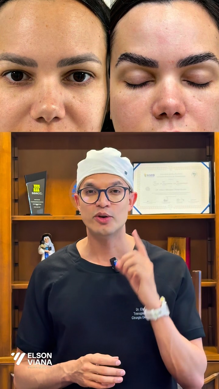 Dr. Elson Viana Facebook ad: Antes e depois de transplante de sobrancelhas com…