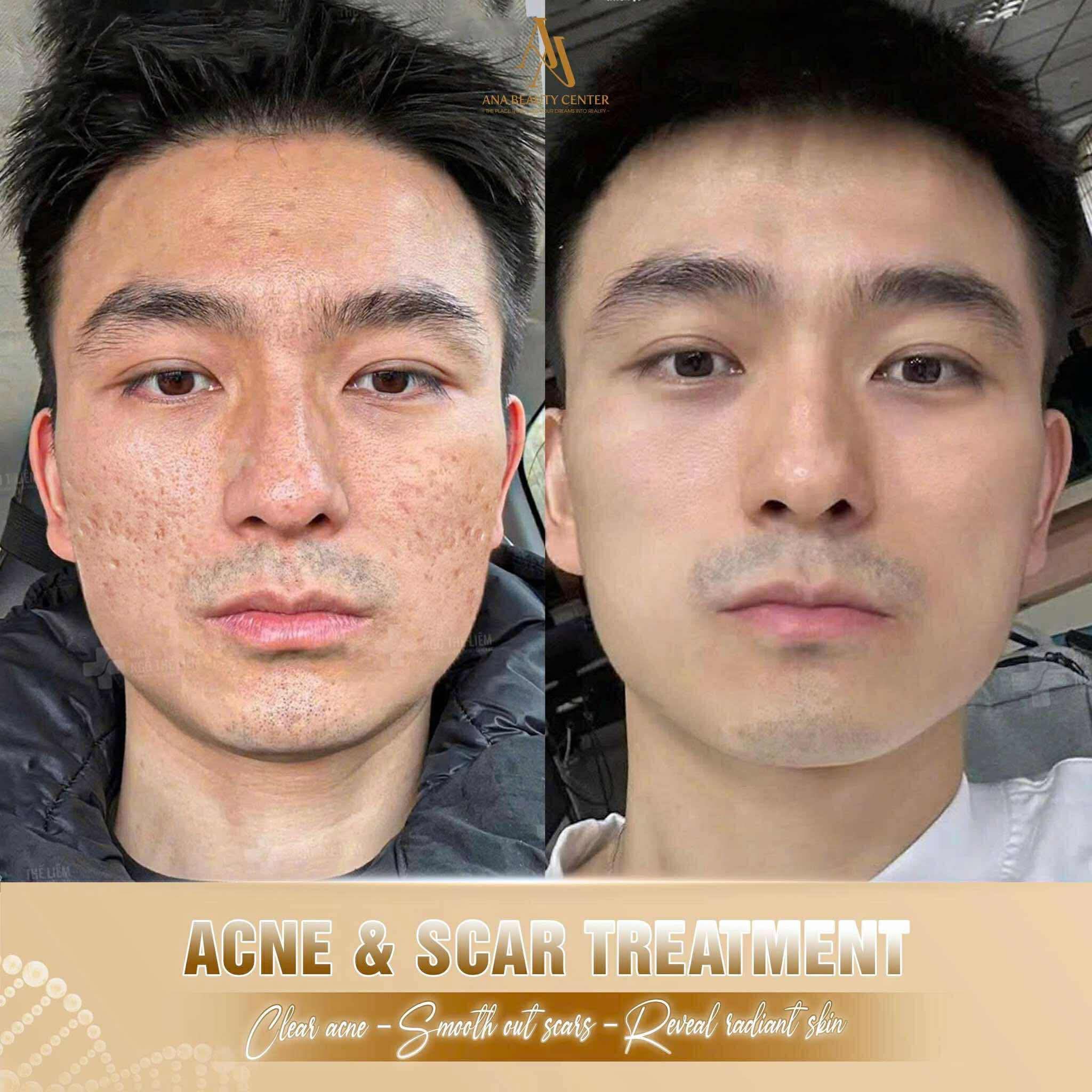Ana Beauty Center Facebook ad: ACNE & SCAR TREATMENT, MEDICAL SKIN RESTORATION