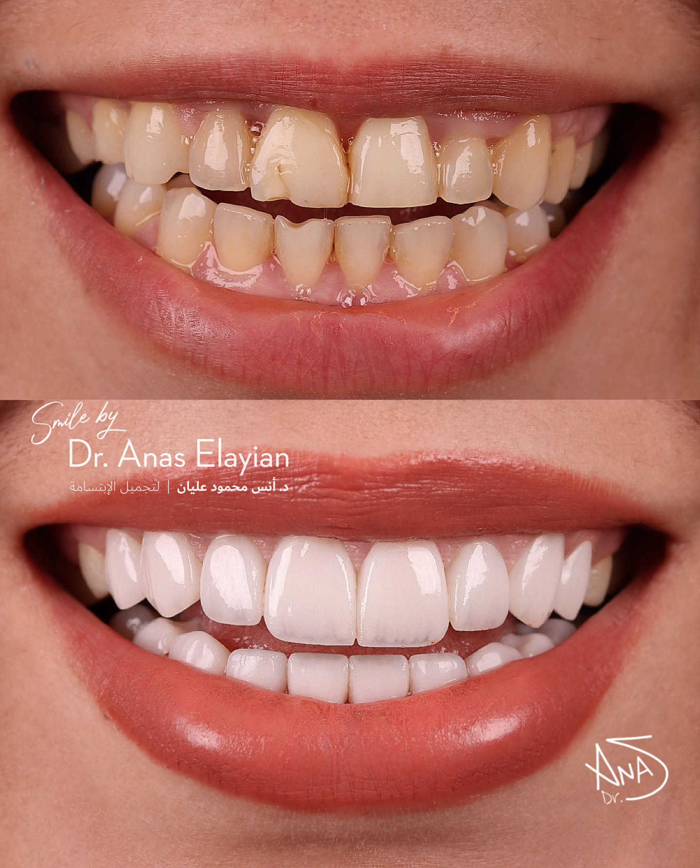 Dr. Anas Elayian د.أنس عليان Facebook ad: Gum Management, then Smile Makeover