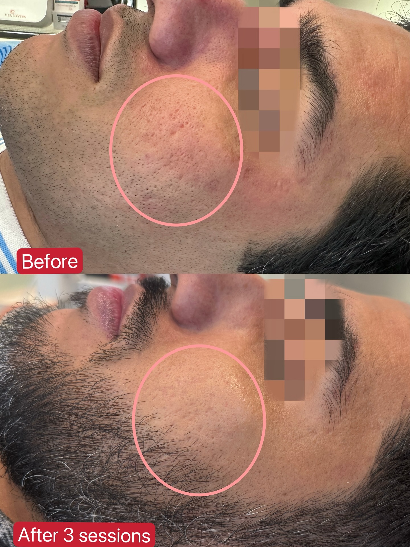 Lanree Aesthetics Facebook ad: Venus Viva Acne Scaring Treatment before & after…