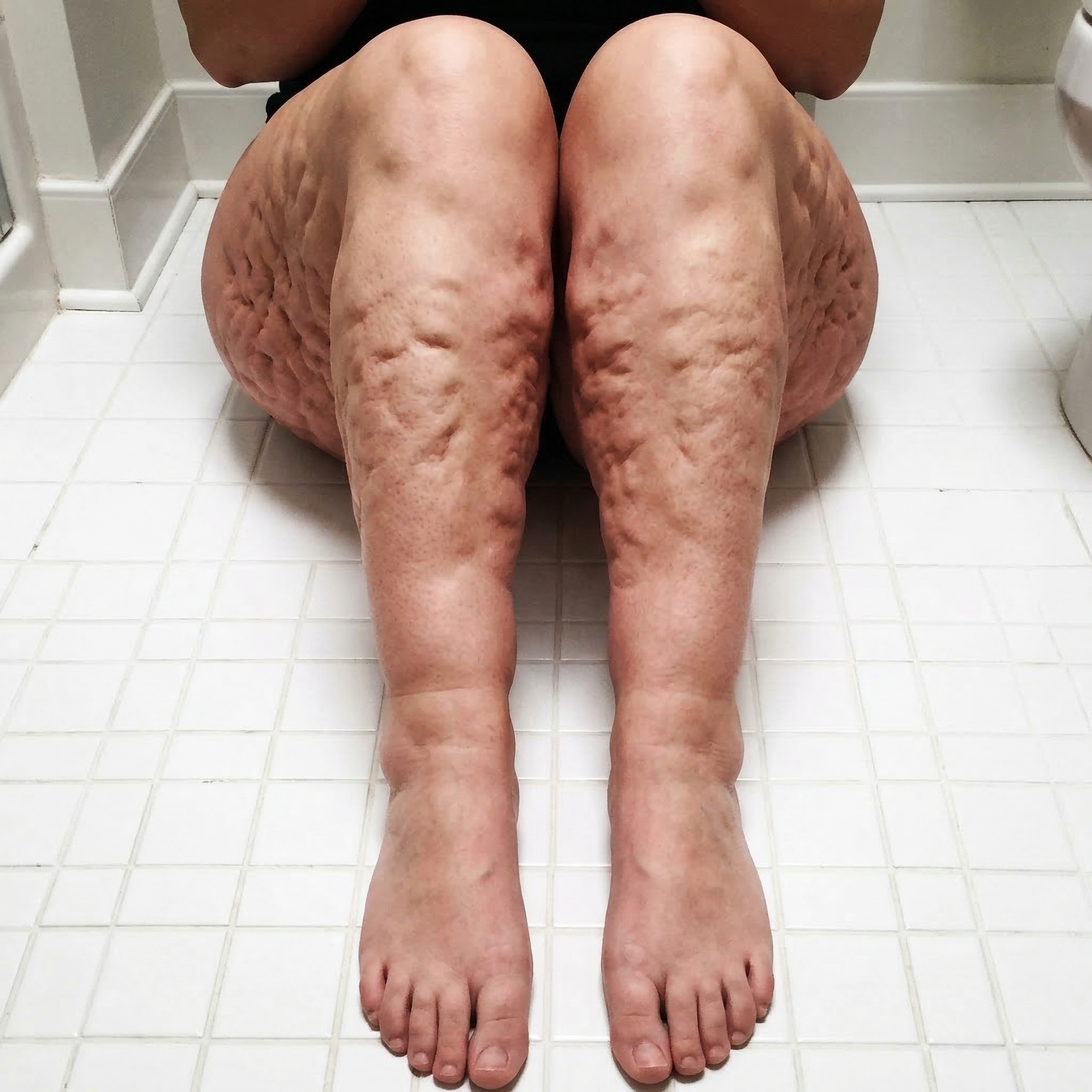 Susan Miller Facebook ad: I've Been Hiding My Legs For 3 Years.