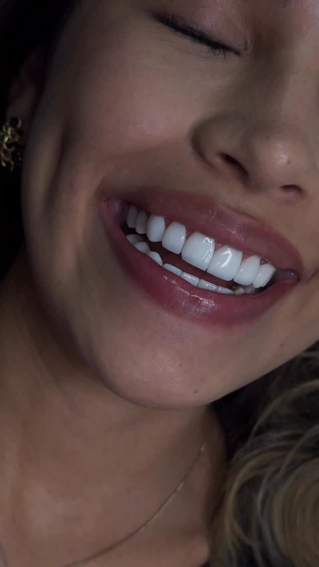 Sonrisa Perfecta Facebook ad: Diseño de sonrisa estratificado con carillas de resina…
