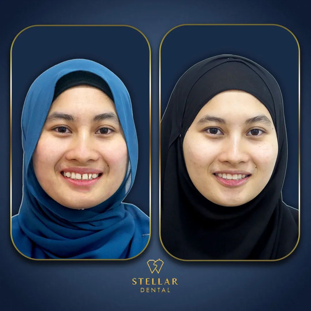 Stellar Dental MY Facebook ad