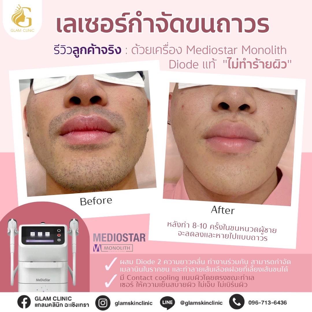 GLAM Clinic แกลมคลินิก ฉะเชิงเทรา Facebook ad: รีวิวเลเซอร์หนวด/ เครา