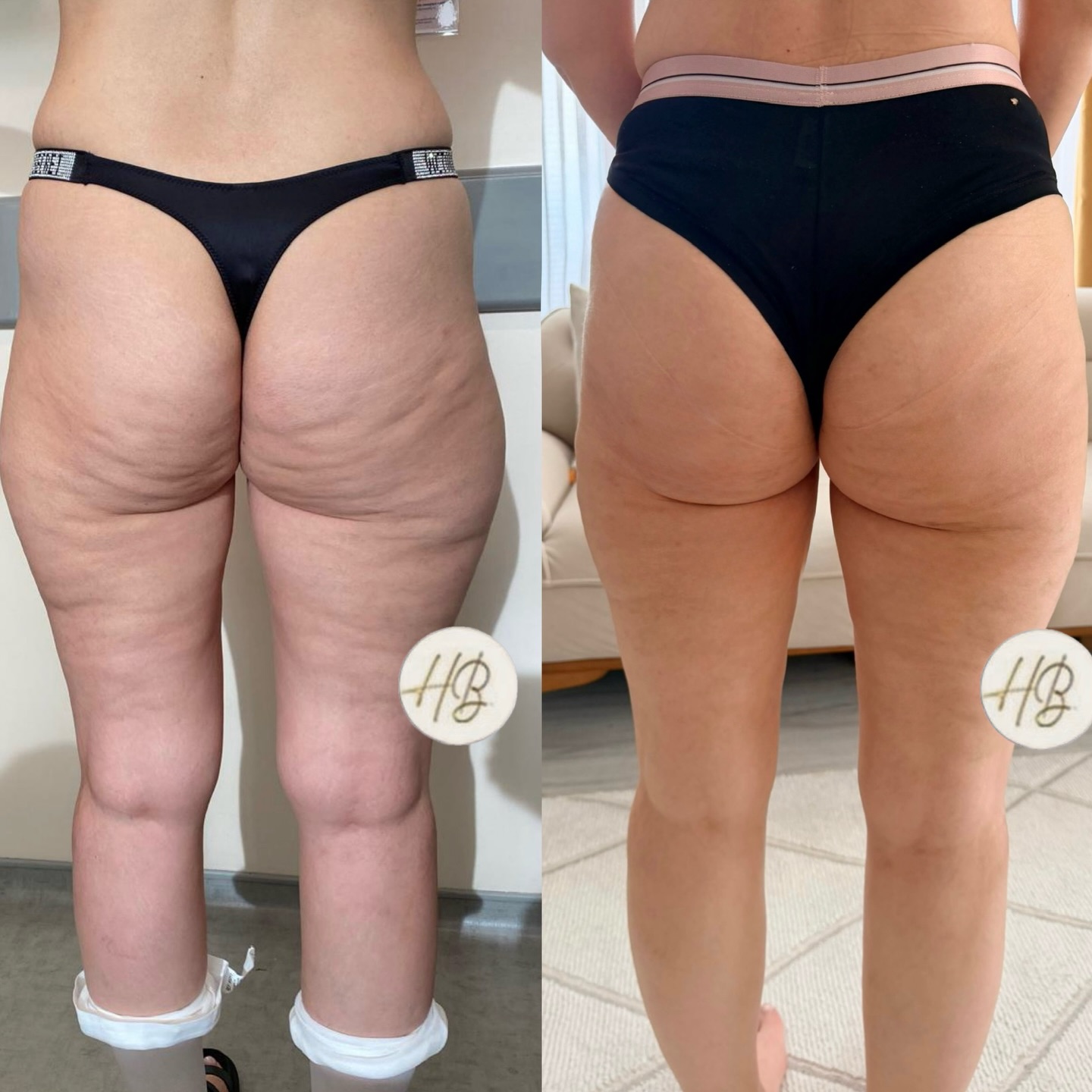 Dr. Big Facebook ad: Selülit Protokolü & Vaser Liposuction ve Lazer ile…