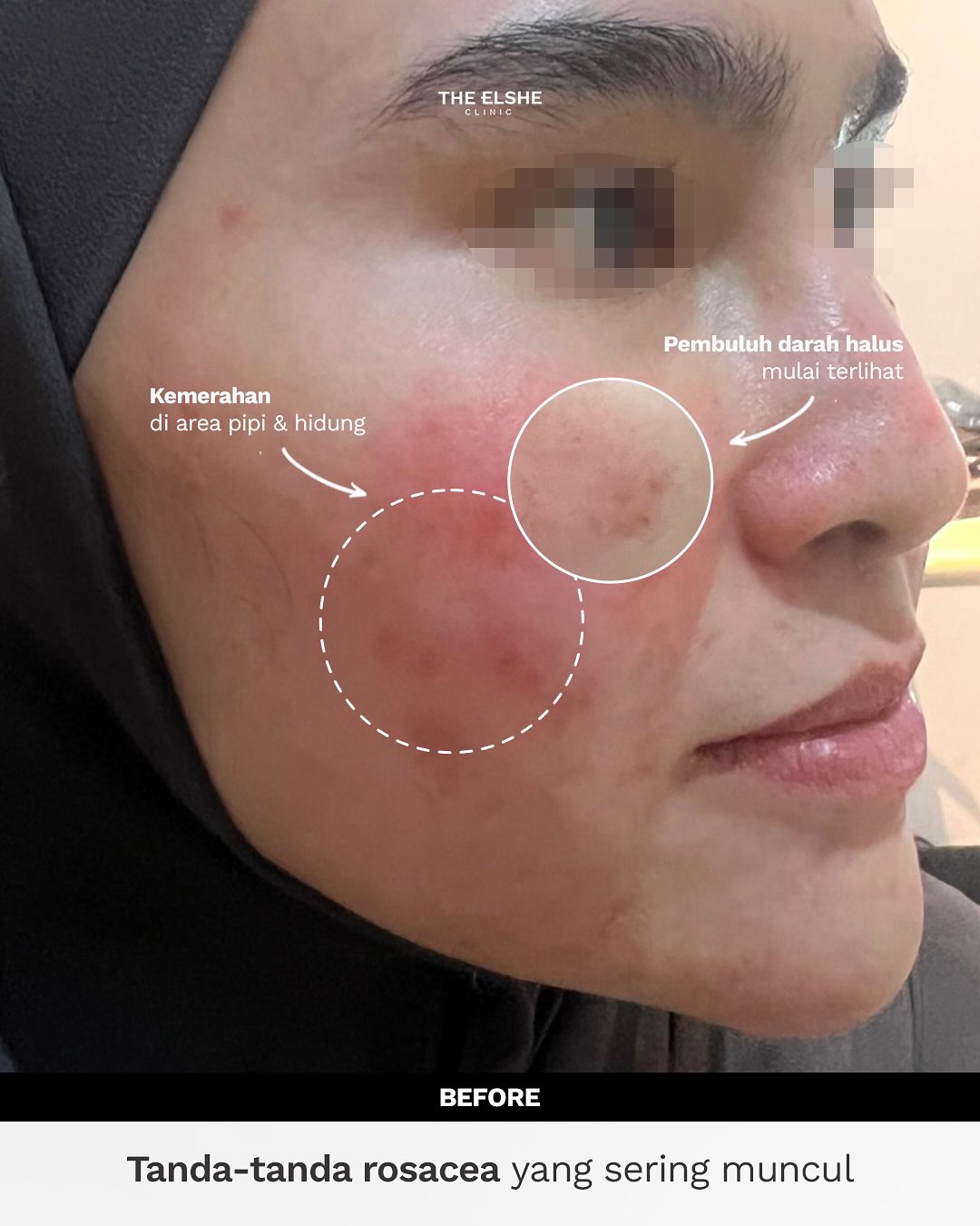 Elsheskinclinic Facebook ad: Kulitmu terus-menerus kemerahan, terasa perih, sensitif…