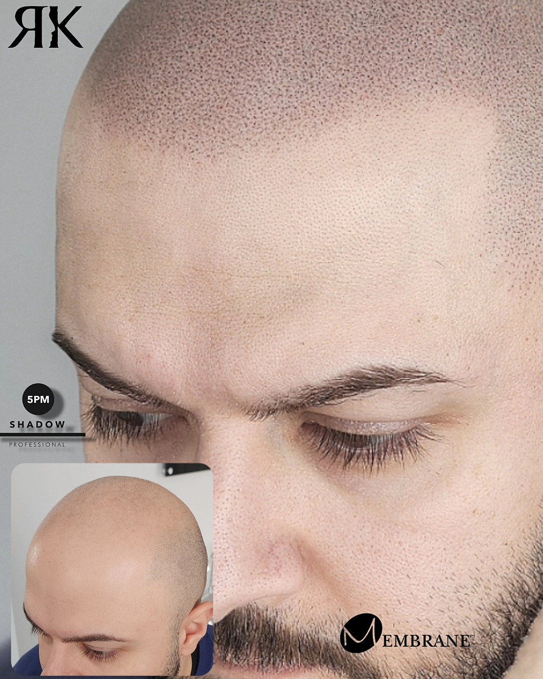 RK Scalp Micropigmentation Facebook ad