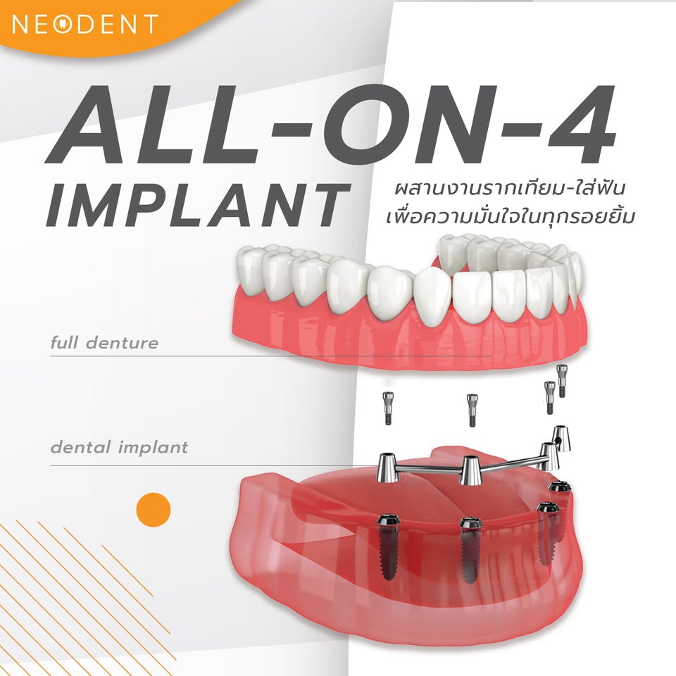 Saha Dental Clinic by Neodent Facebook ad: รากเทียม All-on-4