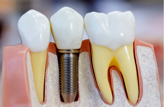 Healdsburg Dental Spa and Fastbraces Facebook ad: Dental Implants - Restorative Dentistry - Healdsburg…