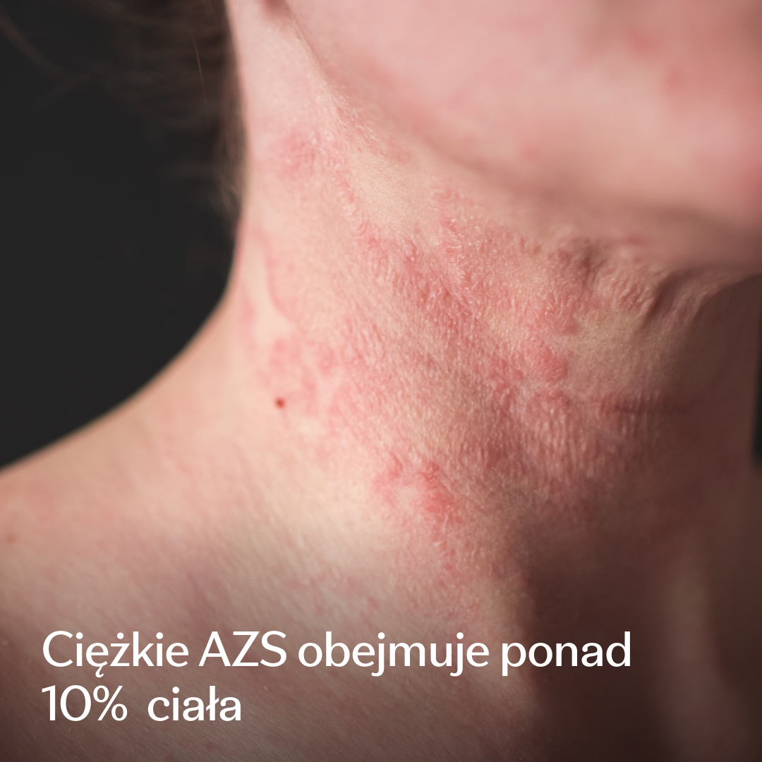 Eczema Research Study Facebook ad: Badanie kliniczne dotyczące ciężkiego AZS