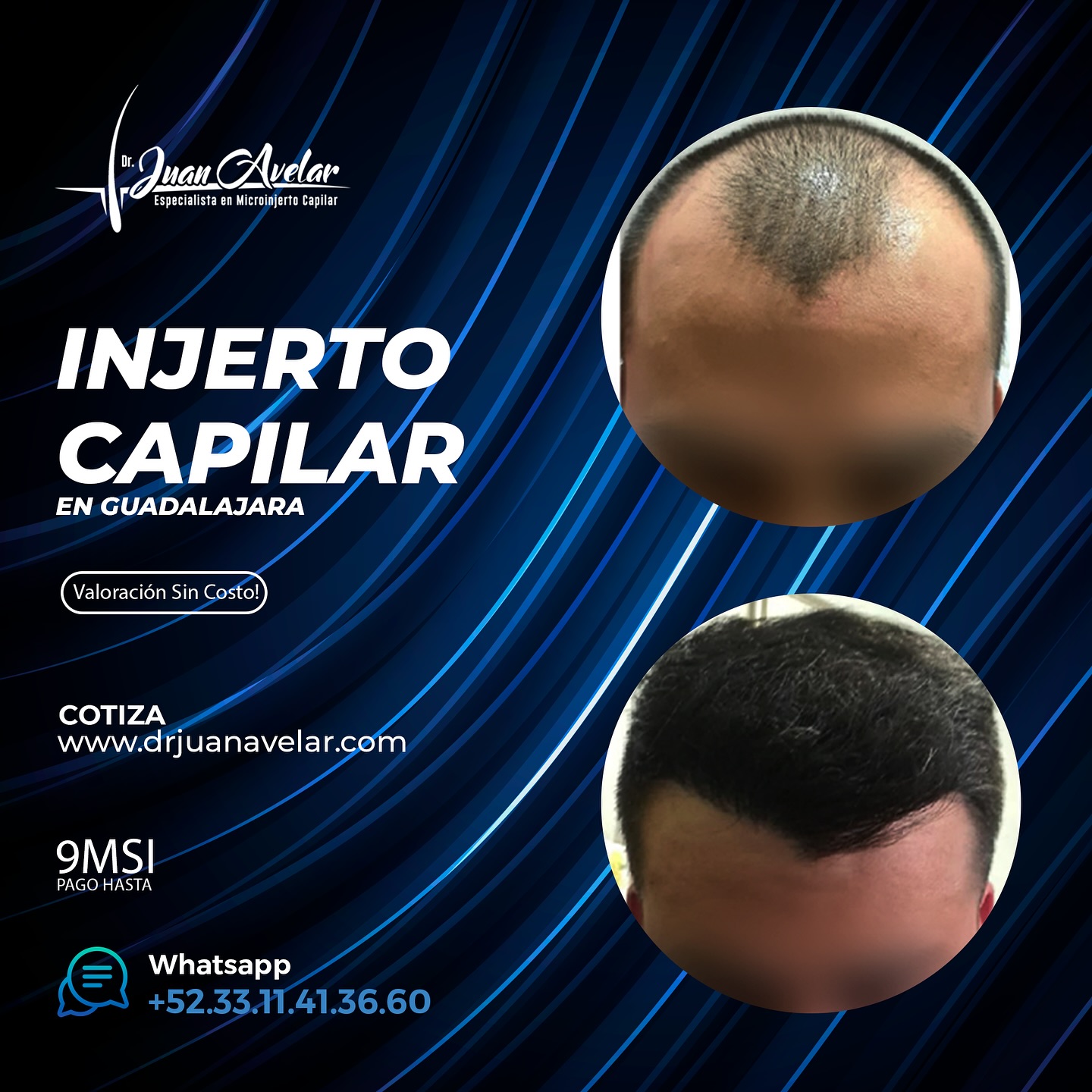 Dr Juan Avelar Especialista en Microinjerto Capilar Facebook ad: Injerto Capilar En Guadalajara, Valoración Sin Costo y…