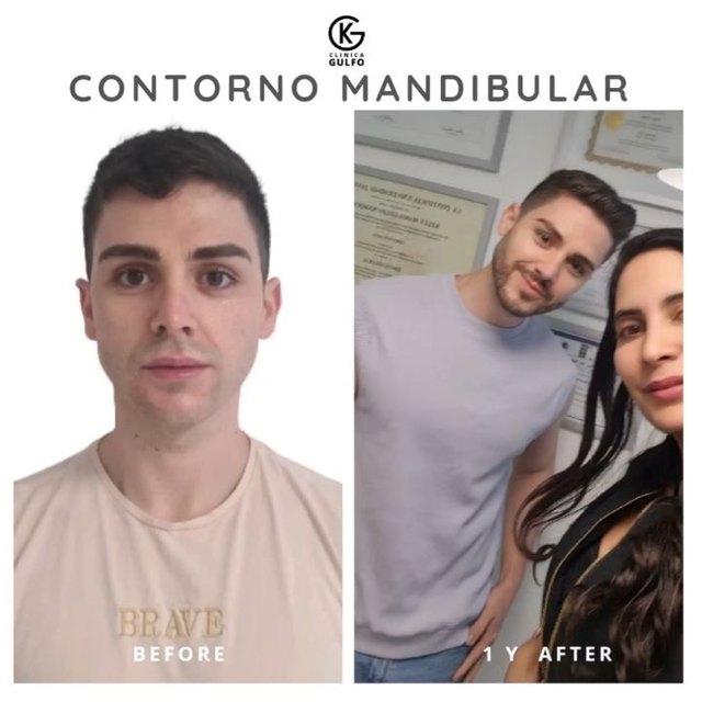 Clinica GULFO Facebook ad: ::CONTORNO MANDIBULAR