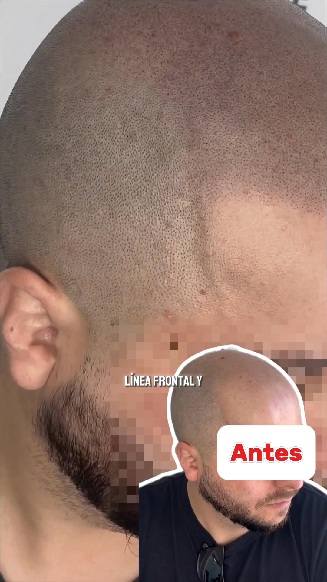 Microfolículo Facebook ad: Efecto rapado