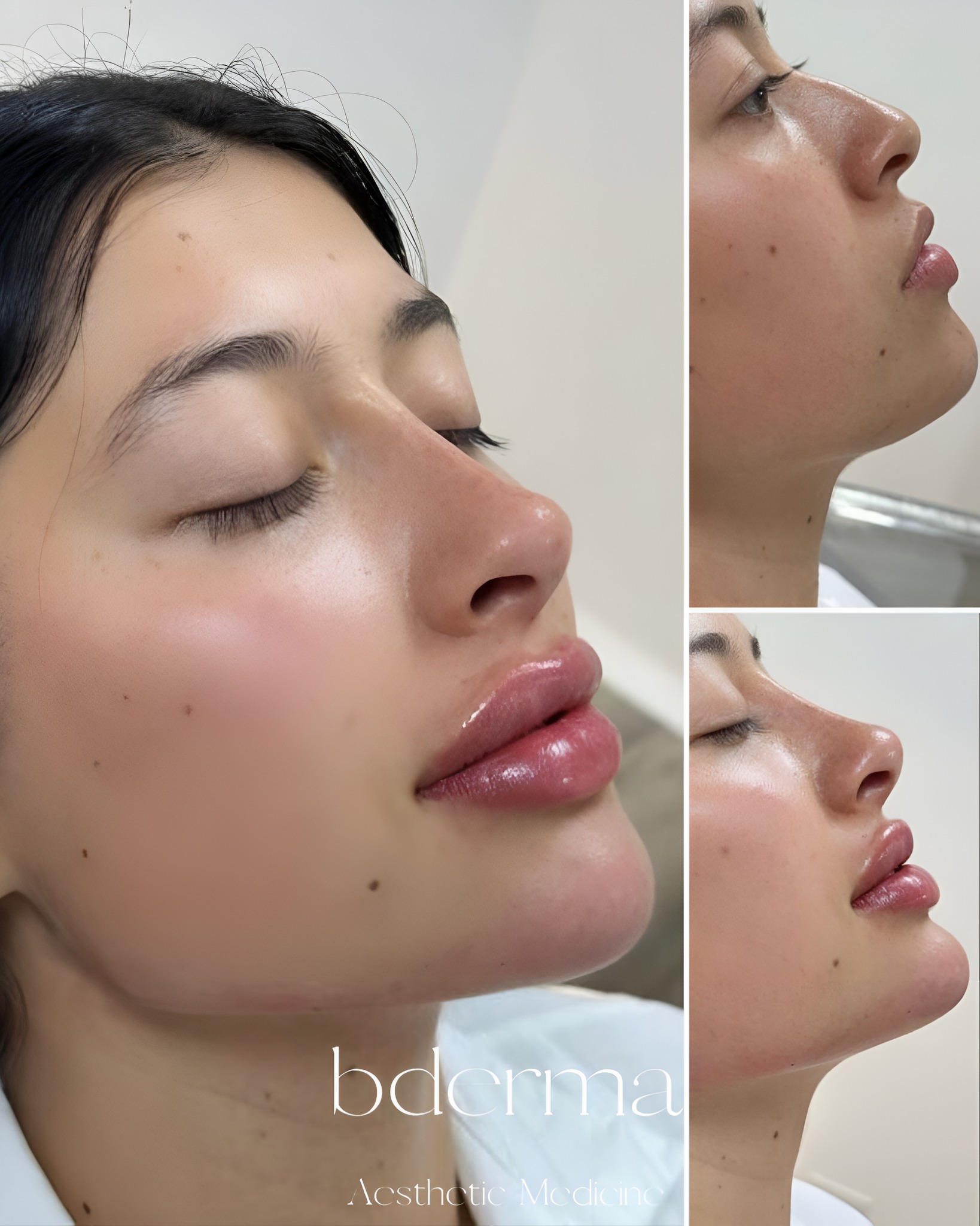 Clínica bderma Facebook ad: Russian Lips