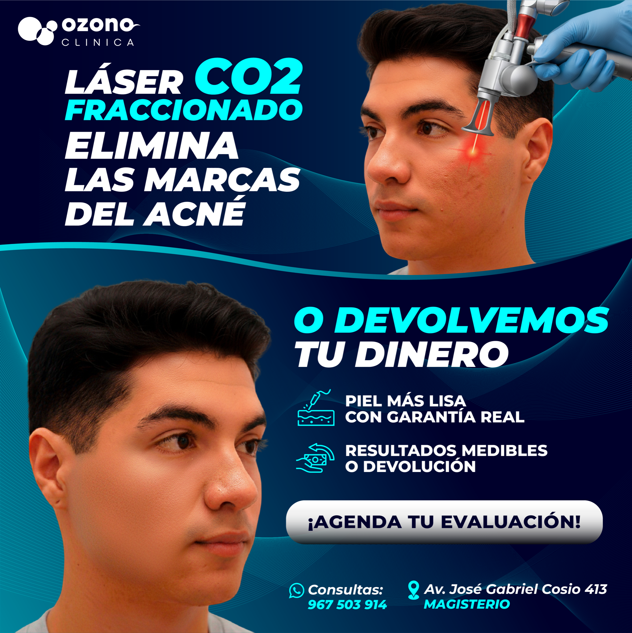Ozonolaser Facebook ad: ELIMINA LAS MARCAS DEL ACNÉ CON LÁSER CO2