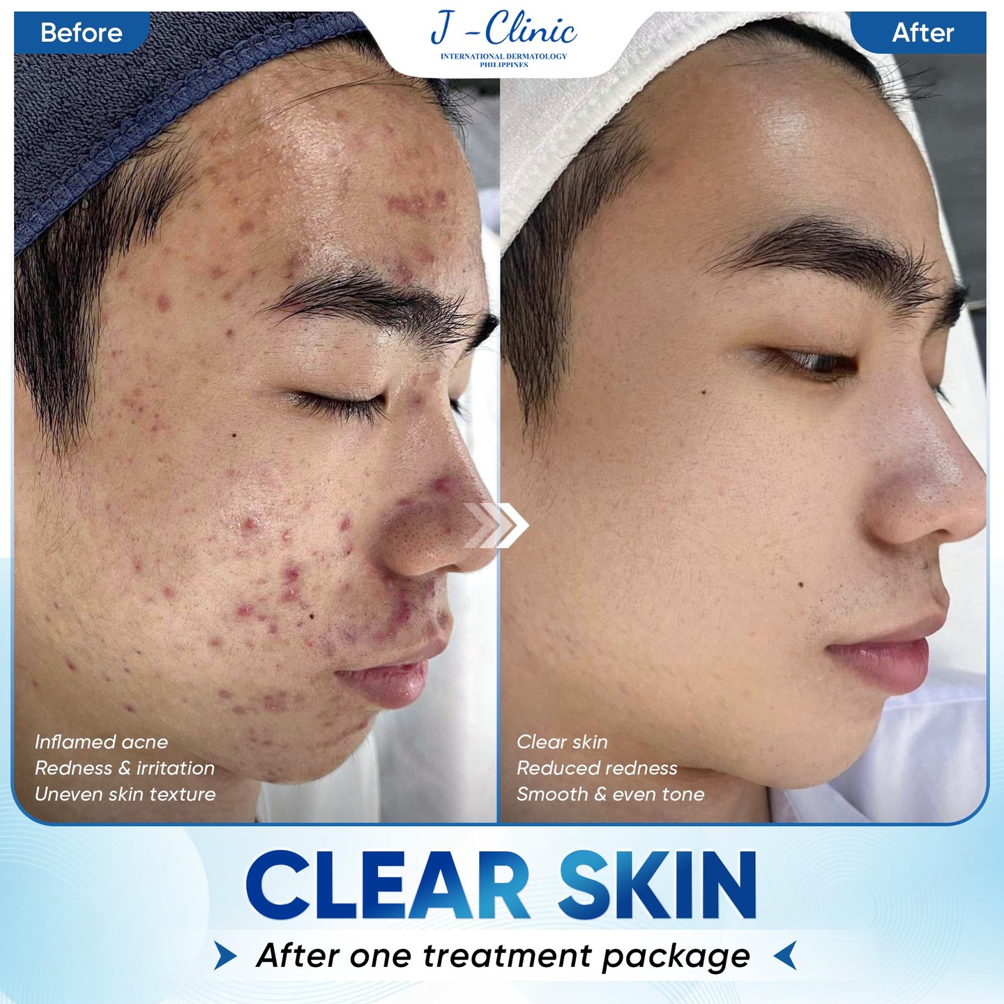 Handbag Facebook ad: INFLAMED ACNE, AFFECTING YOUR CONFIDENCE IN EVERY…