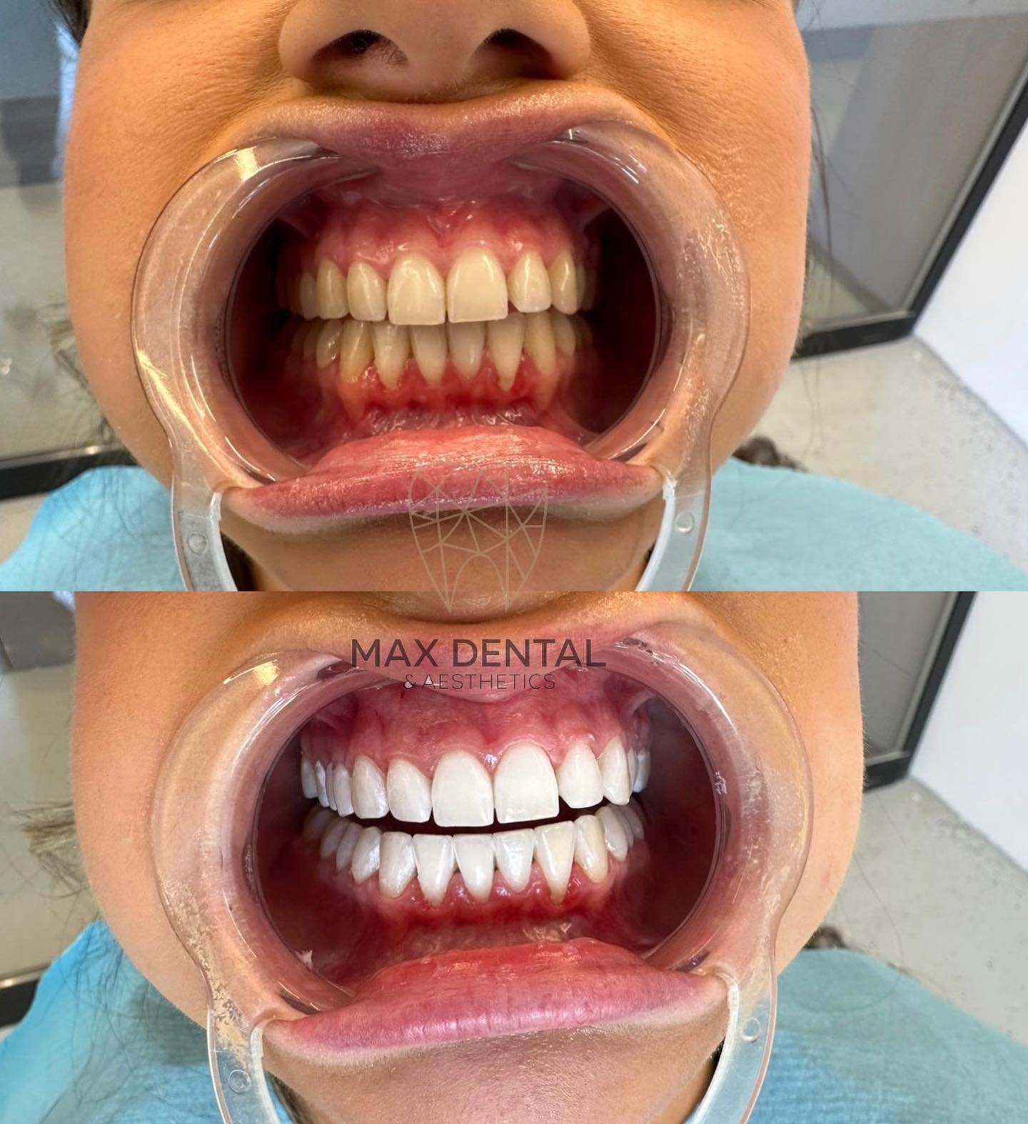 Max Dental & Aesthetics Facebook ad: Magical teeth whitening in our clinic