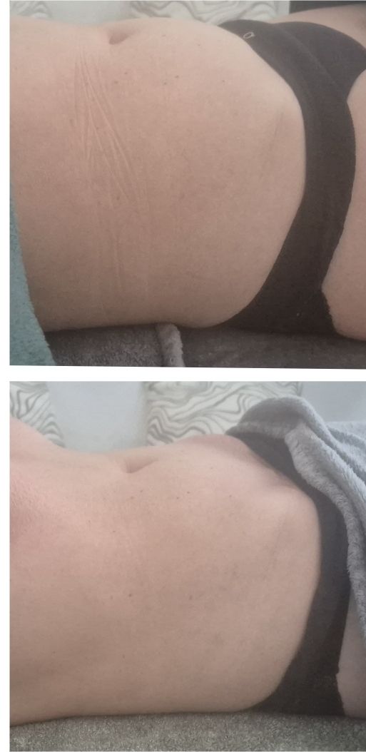 blissful bodyworks runcorn 2 Facebook ad: Lymphatic drainage massage body sculpting results