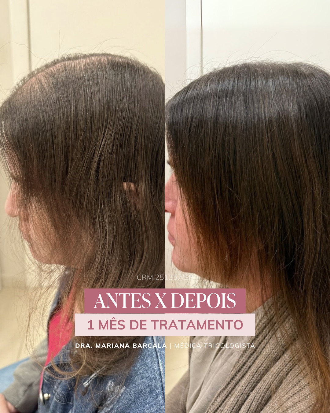 Dra Mariana Barcala Facebook ad: 1 mês de tratamento, e os fios já…