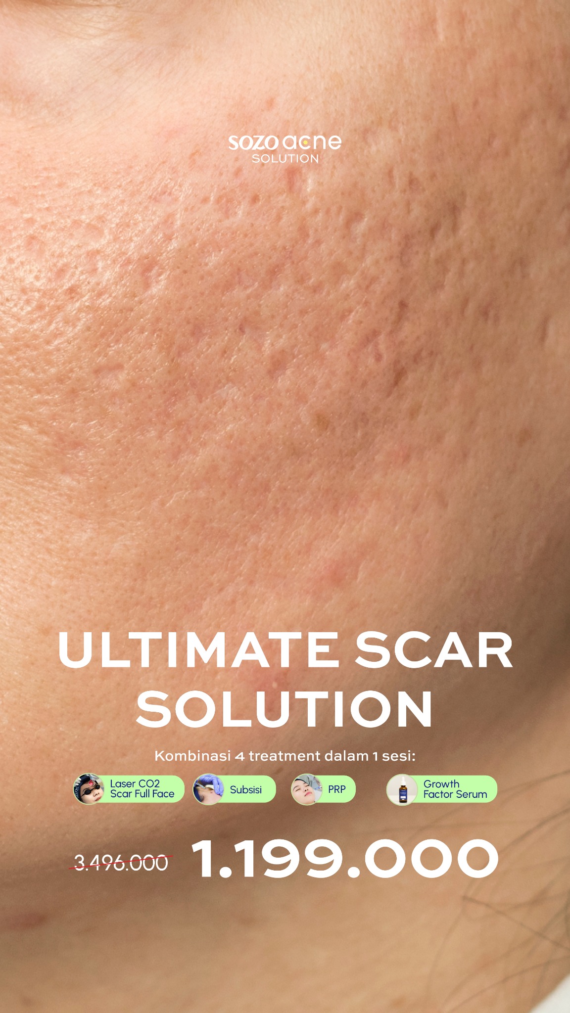 Sozo Acne Facebook ad