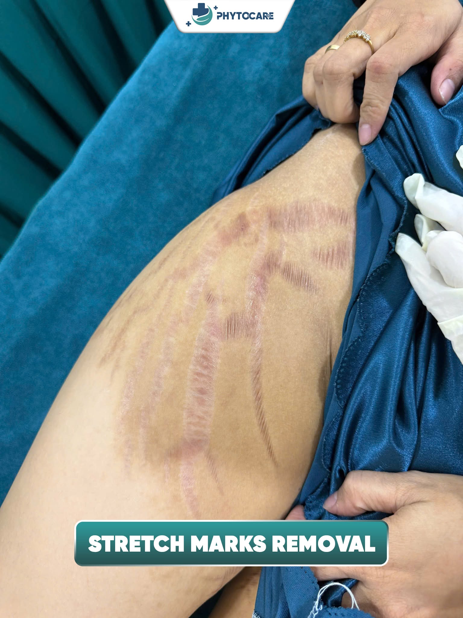 Phytocare Dermatology Cebu Facebook ad: Stretch marks on the upper arms can appear…