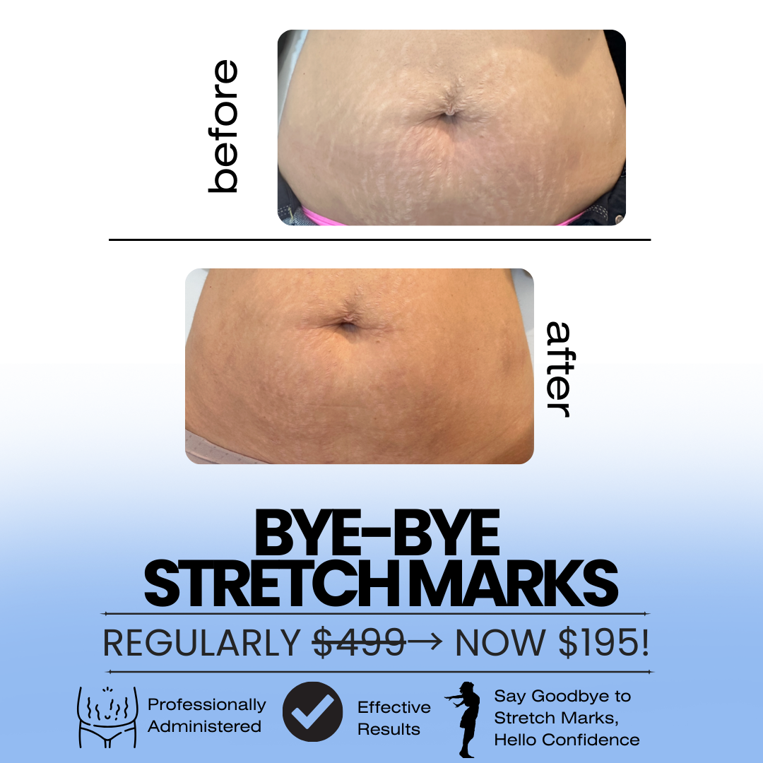 The GLO Skin Tight Laser Club NOMAD Facebook ad: Fade Stretch Marks and Renew Your Skin with our Bye-Bye…