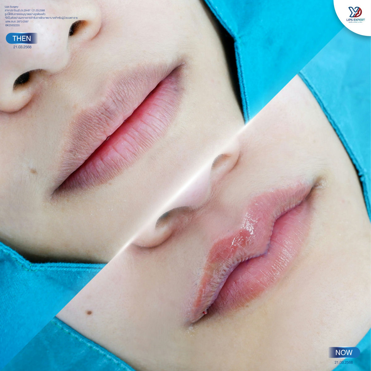 หมอบอล ปากกระจับ - Youngdo Clinic Facebook ad: เบื่อปากตรงๆ อยากได้ปากกระจับน่ามอง