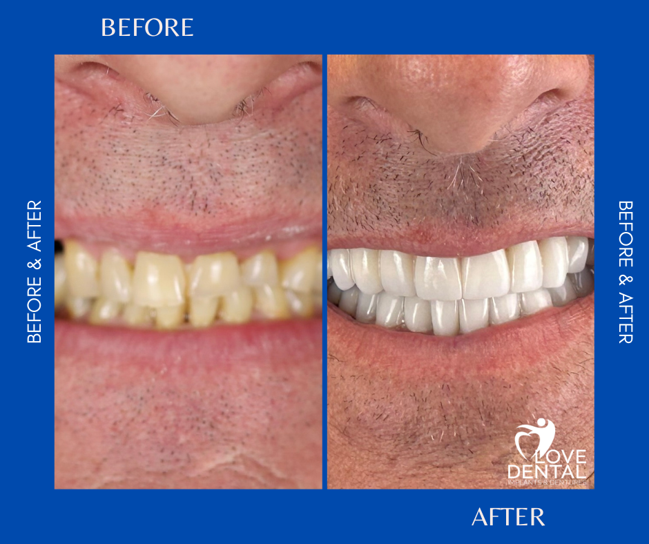 Love Dental Implants & Dentures Facebook ad: Free Implant Consultation