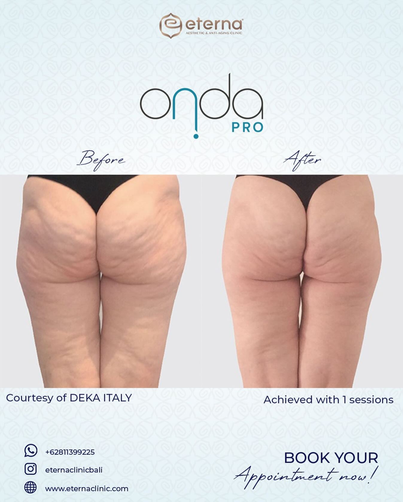Eterna Aesthetic & Anti Aging Facebook ad: Smoother and tighter skin in one painless session?