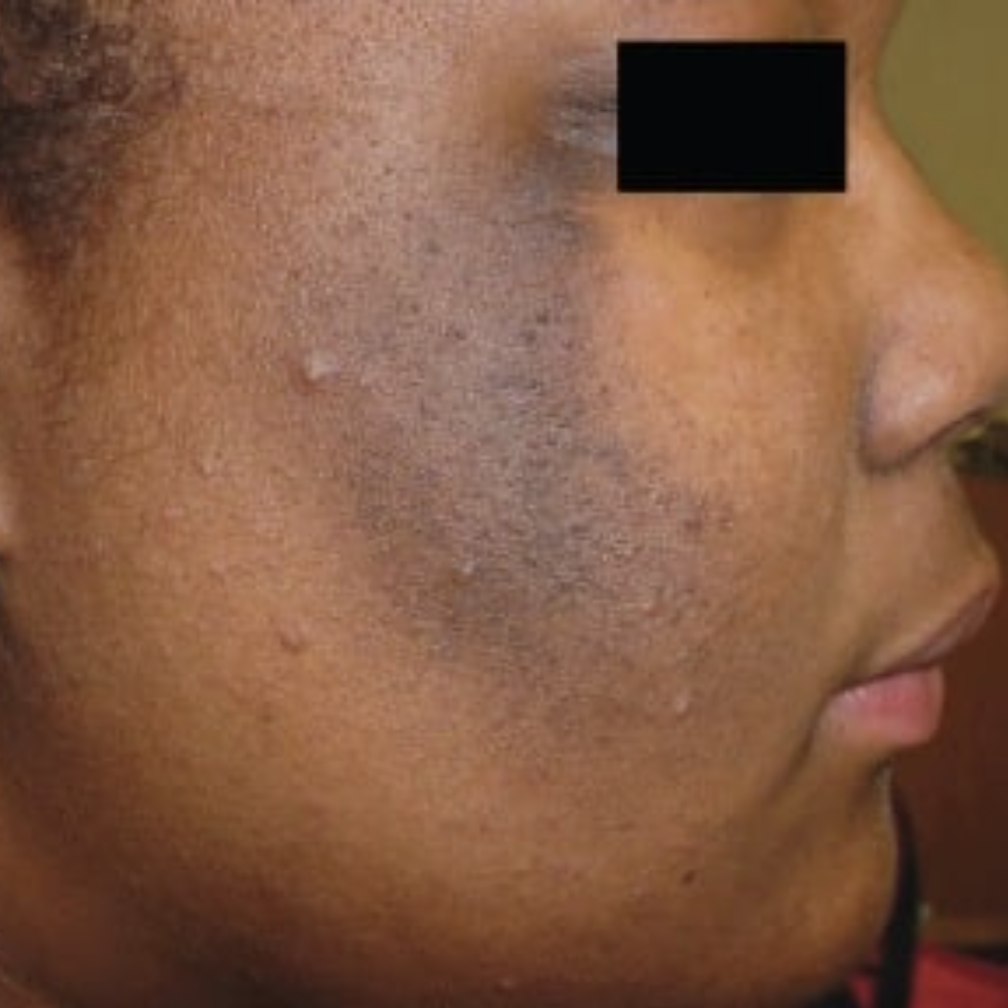 Esthetician Tanisha Freeman Facebook ad: I Always Warn My Patients About This.