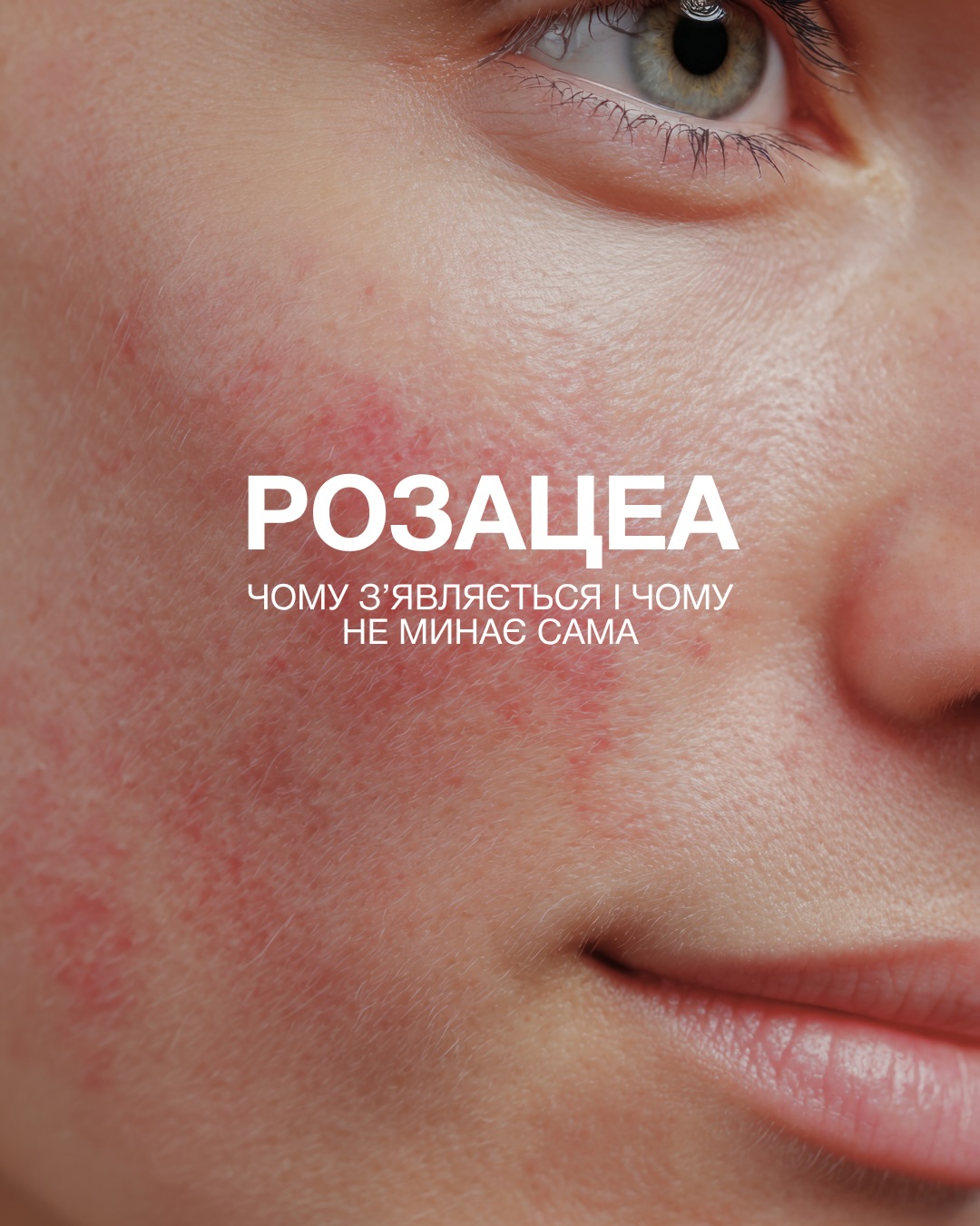 ICON Aesthetic Clinic Facebook ad: Розацеа, це не просто тимчасове почервоніння