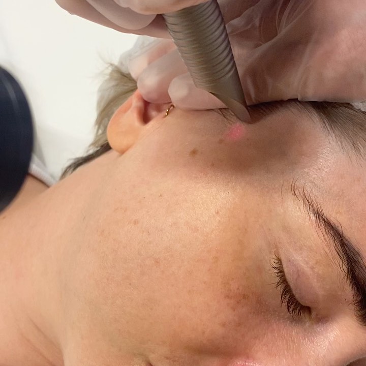 Klinikk Asena As Facebook ad: Fotona Smooth eye/ Peel