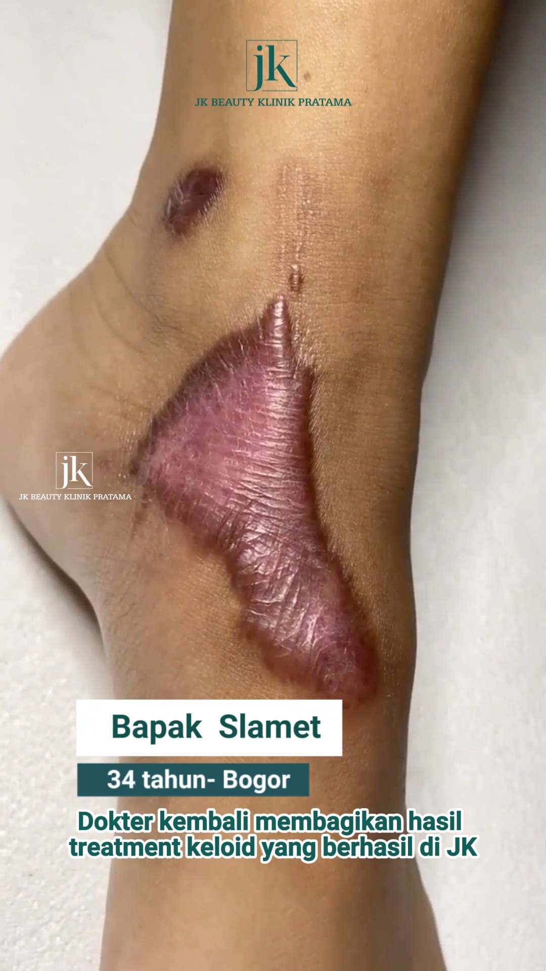 Scarmax - JK Beauty Klinik Pratama Facebook ad: BEKAS LUKA DI PERGELANGAN KAKI BUKAN HANYA MENGGANGGU…